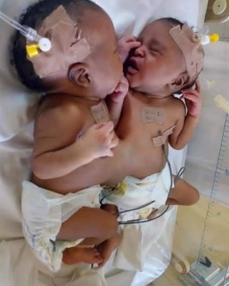 Opération de séparation de bébés siamois réussie au Nigeria (photo)