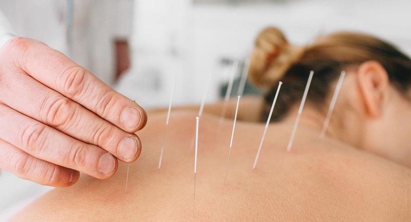 Acupuncture : voici 5 choses à savoir pour éviter les idées reçues