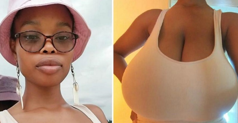 Avec une poitrine en forme de pastèques, la chirurgie a changé sa vie