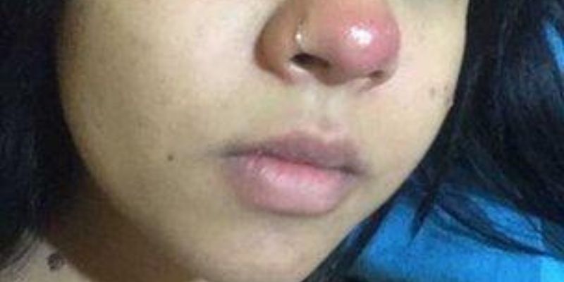 Brésil : un piercing au nez rend paraplégique une jeune fille de 20 ans