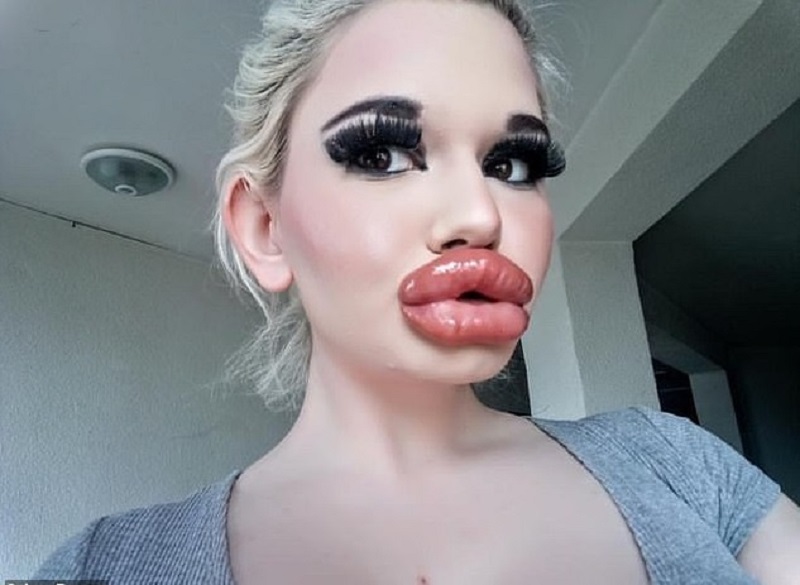 Bulgarie : une jeune dame accro aux injections dans ses lèvres pour être belle (vidéo)