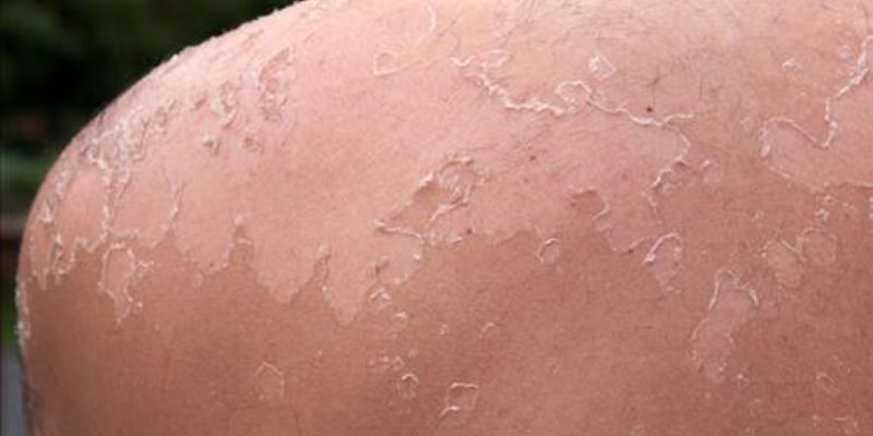 Cancer de la peau : l’effet insoupçonné des rayons UV
