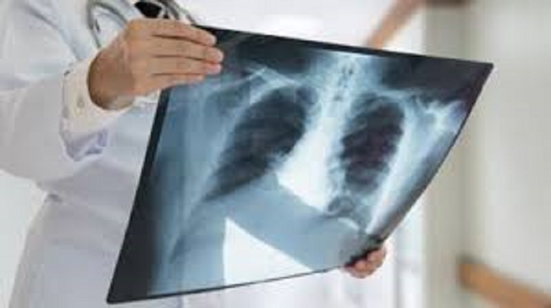Cancer du poumon :  ces changements sur les doigts qui ne trompent pas