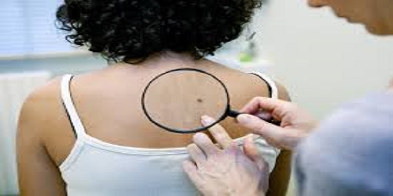 Ce facteur augmenterait de 80 % le risque de cancer de la peau