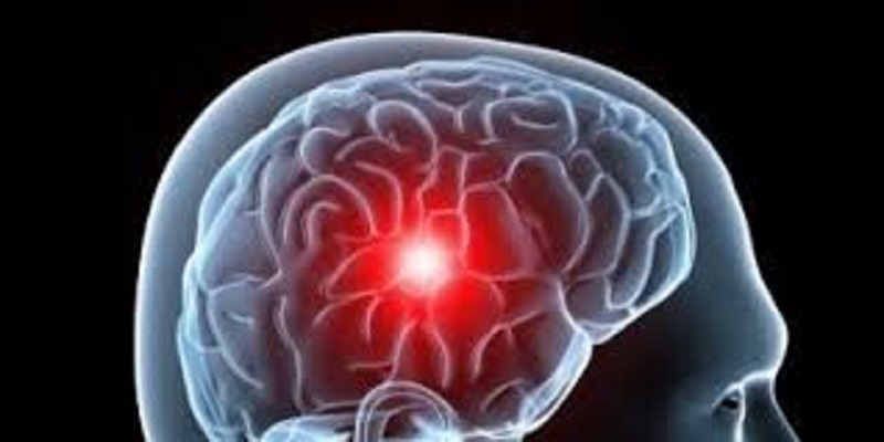 Cette découverte permettra de diagnostiquer les micro-AVC à un stade précoce