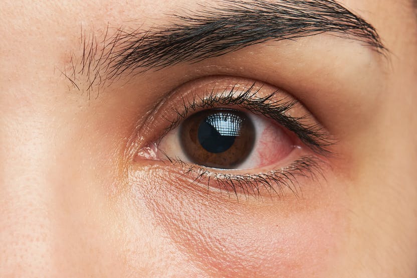 Covid-19 : le virus favoriserait une rare infection néfaste pour les yeux