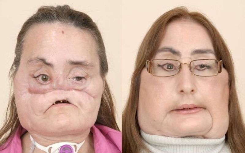 Décès de la première Américaine ayant reçu une greffe du visage 
