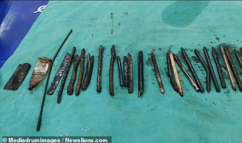 Des médecins retirent 33 objets, dont des lames de rasoir et un tournevis, du ventre d’un homme de 30 ans