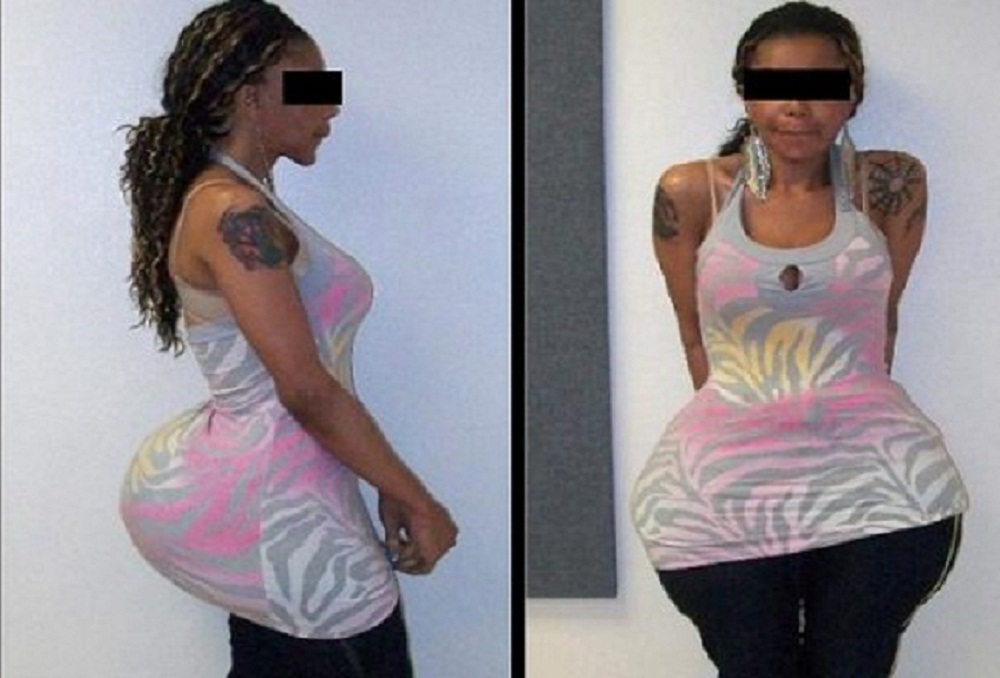 Elle devient paralysée en voulant modifier la forme de ses fesses