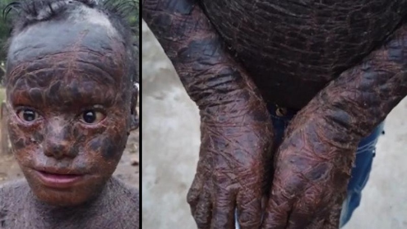 « Homme serpent » : atteint d’une maladie rare, ce garçon perd sa peau toutes les 6 semaines (vidéo)