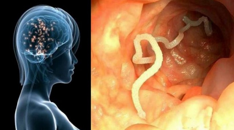Il vit avec un ver solitaire dans le cerveau pendant 10 ans (photo)