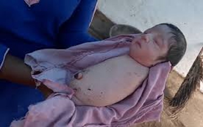 Inde : un bébé naît en bonne santé sans bras ni jambes