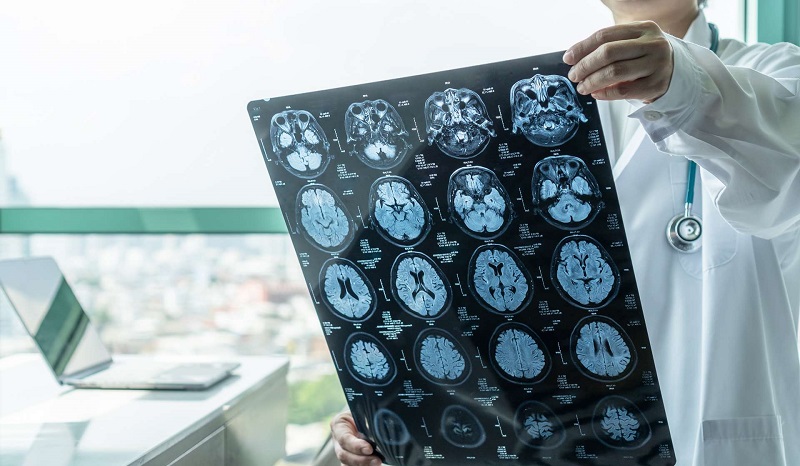 La Covid-19 entraîne des anomalies cérébrales, selon une étude