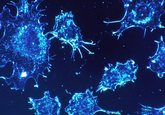 La cause de l’un des cancers les plus dangereux découverte