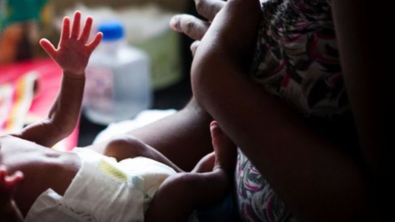 Inde : un bébé naît avec 4 jambes et 3 bras