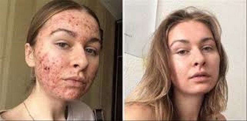 Le chocolat a totalement ruiné sa peau (photo)