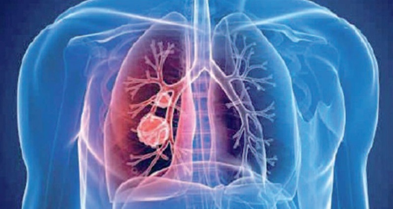 Le coronavirus pourrait causer des embolies pulmonaires chez les jeunes guéris