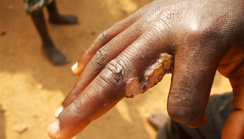 Le secret d’une infection dangereuse sévissant dans le Pacifique enfin découvert