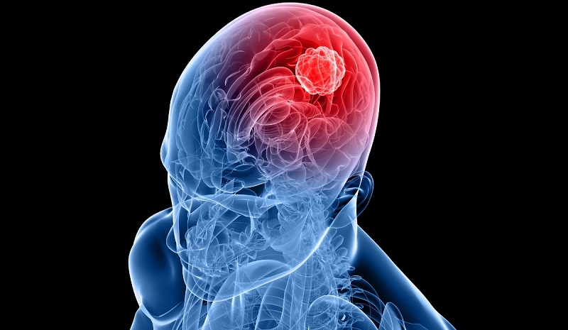 « Le symptôme le plus courant » du cancer du cerveau désigné