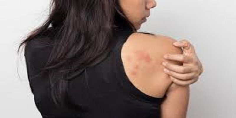 Les dermatologues mettent en garde contre d’éventuels symptômes cutanés du coronavirus
