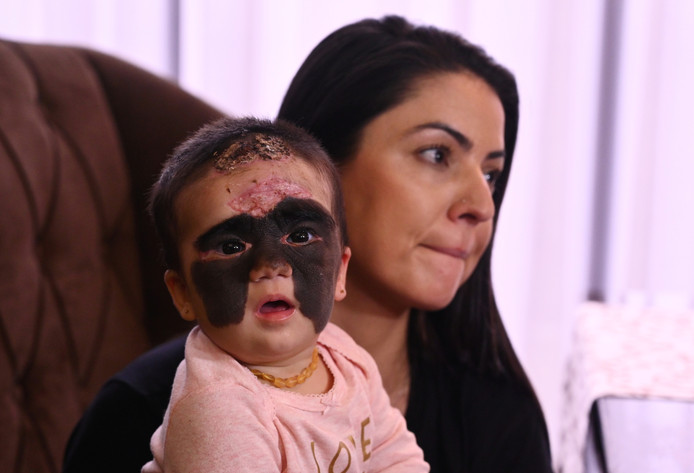 Luna est surnommée “bébé Batman” en raison d’une maladie rare de la peau