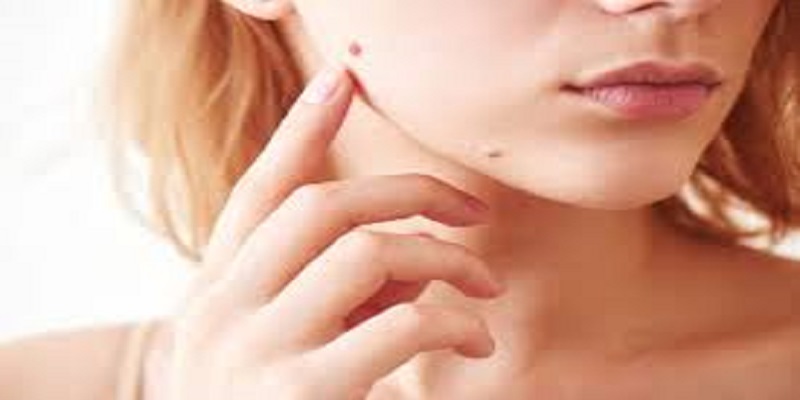 Quand est-ce qu’un grain de beauté rouge présente un danger ? un cancérologue explique