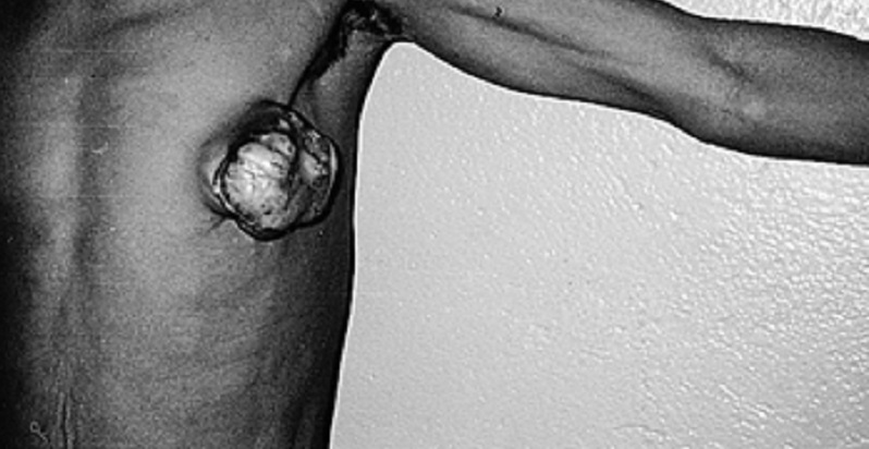Togo : Cancer du sein chez l’homme, plus de 80 patients diagnostiqués au CHU de Lomé