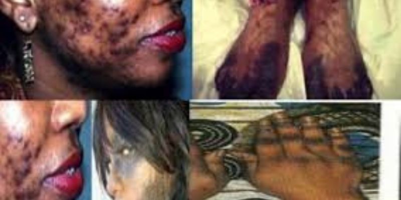 Togo : la dépigmentation, un phénomène qui prend de l’ampleur à Lomé