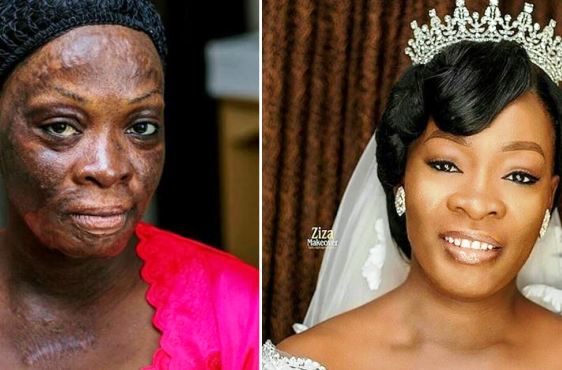 Incroyable, mais vrai : une survivante de brûlure obtient une métamorphose inédite le jour de son mariage (photos)
