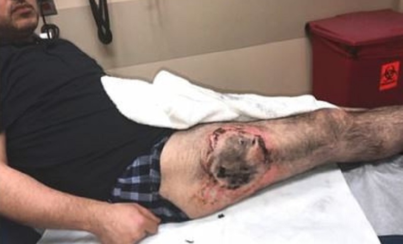 Un homme brûlé au 3e degré à la cuisse après l’explosion de la batterie de sa vape