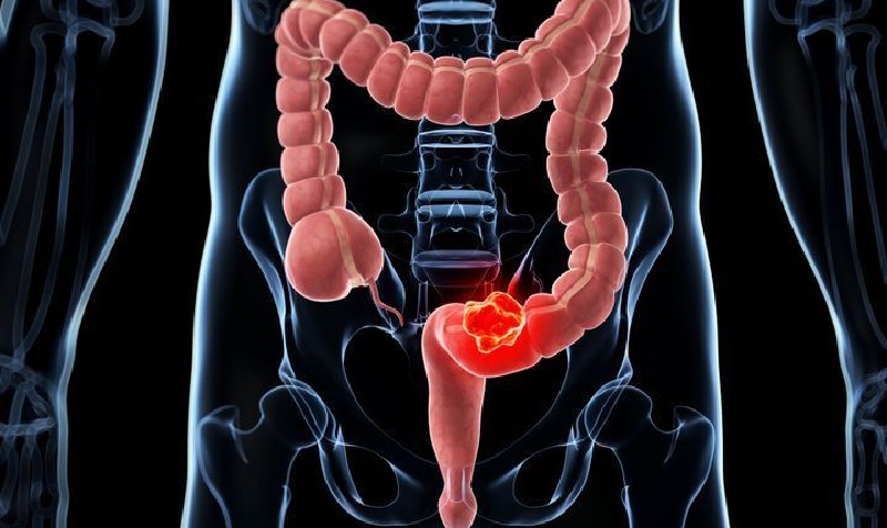 Un moyen de prévenir l’un des cancers les plus fréquents trouvé