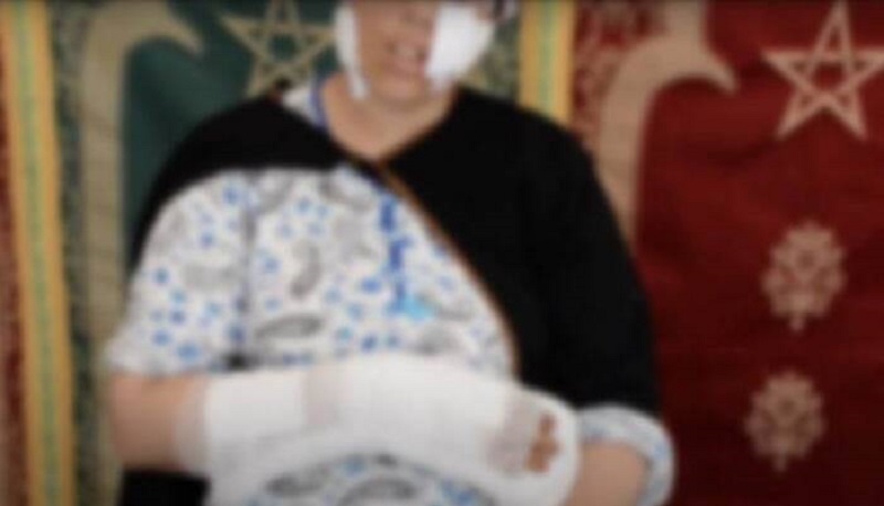 Une Marocaine défigurée par son mari avec une machette pour une question de jalousie (vidéo)