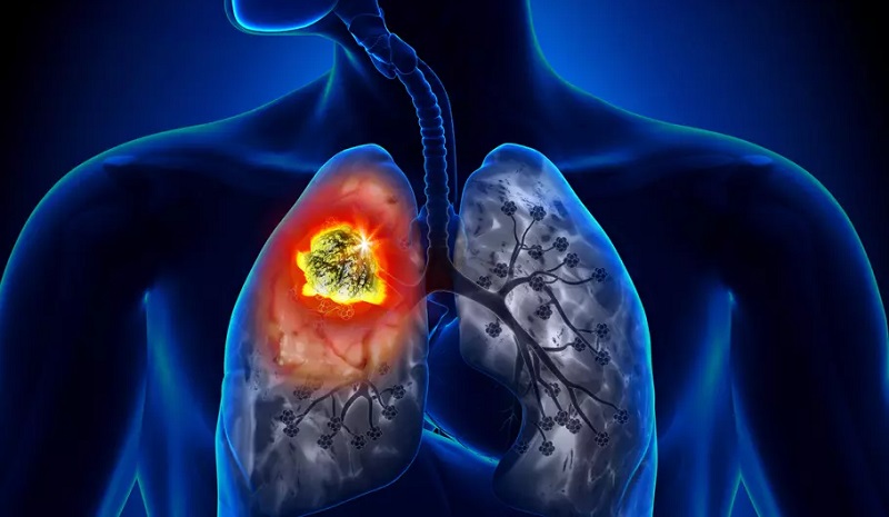 4 facteurs qui causent le cancer du poumon en dehors de la cigarette