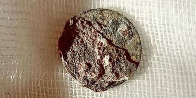 Une pièce vielle de 50 ans sortie du nez d’un patient (photo)