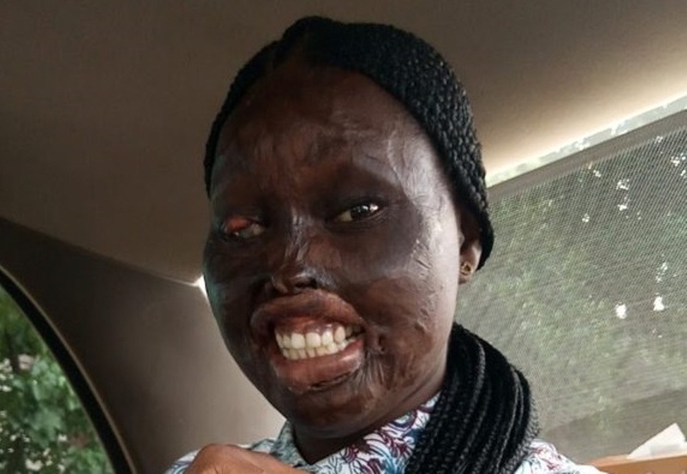 Victime d’une attaque à l’acide et après avoir perdu la vue d’œil, cette jeune fille obtient son diplôme de biochimie malgré son handicap