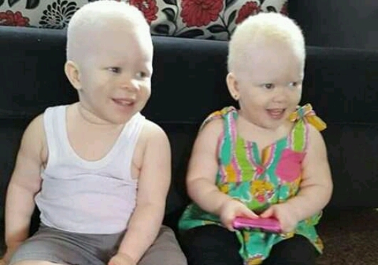 Sur nous albinos, ayez un regard positif !