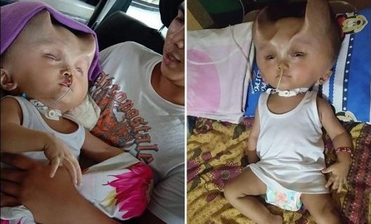 Incroyable : ce bébé pousse des « cornes » après une opération chirurgicale