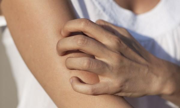 Comment soulager naturellement les démangeaisons ?
