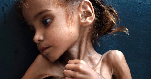 Yémen : fin tragique pour la petite fille dont la photo est devenue symbole de la famine