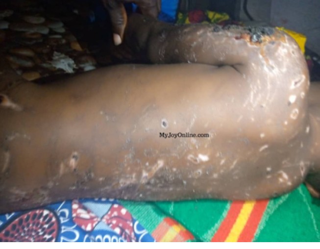 Ghana : Un Togolais brûle sa fille de 3 ans parce qu’elle est irrespectueuse
