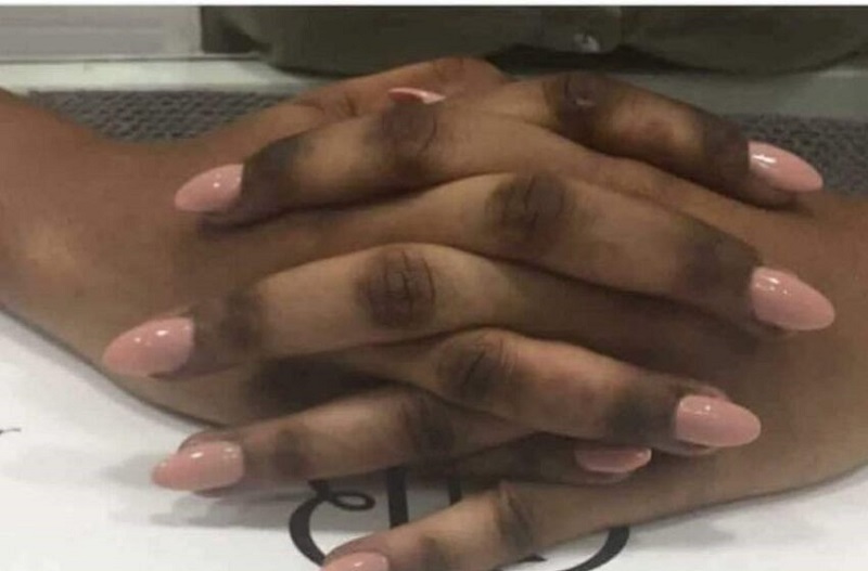Dépigmentation : « Je voulais me rendre belle… », des femmes devenues aveugles au Mali