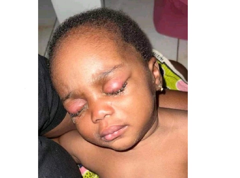Horrible : une nounou met de la colle dans les yeux d’une fillette de 9 mois pour la forcer à dormir