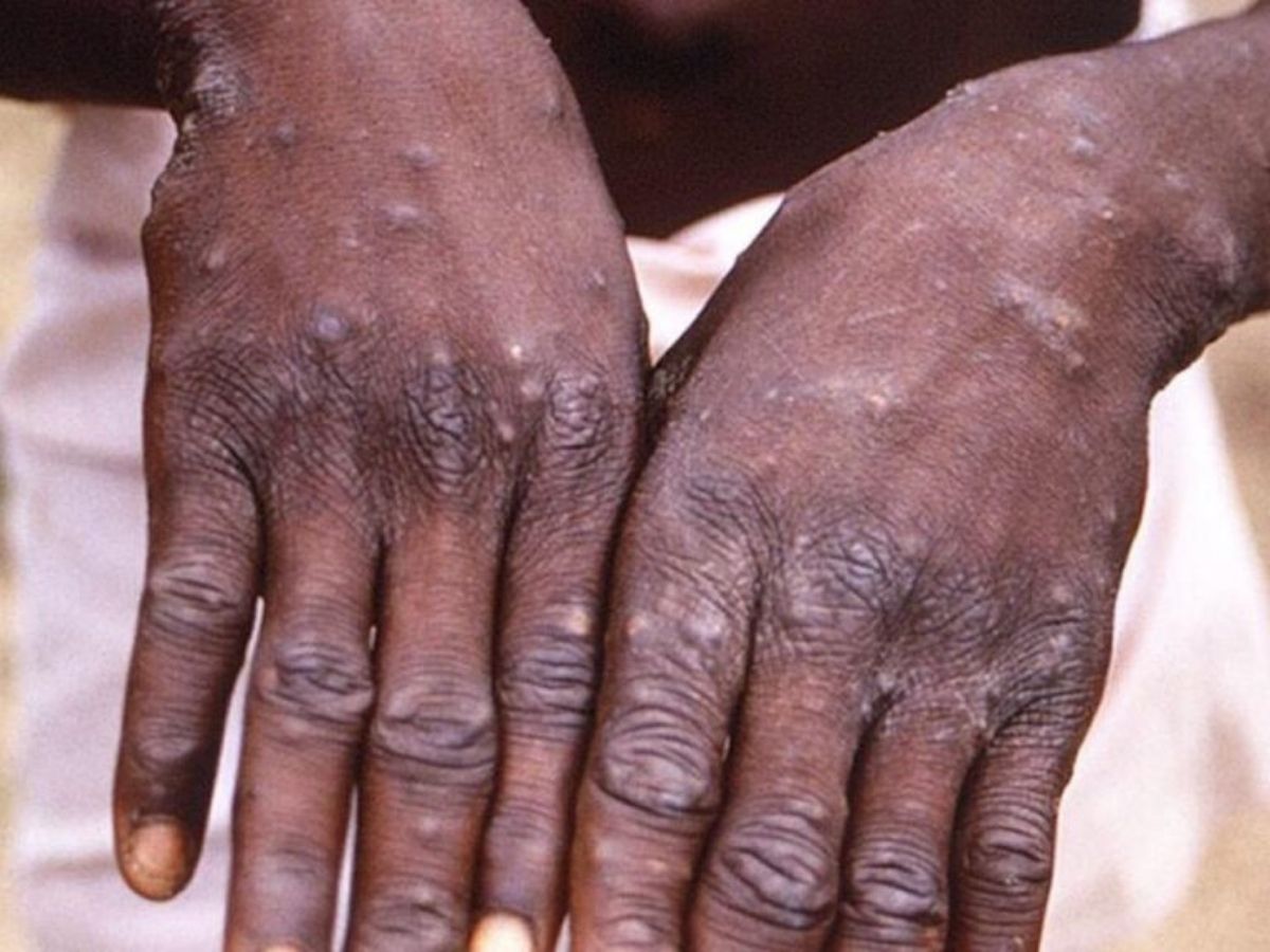 « Il est plus facile d’attraper la variole du singe par les rapports s3xuels et les baisers… »