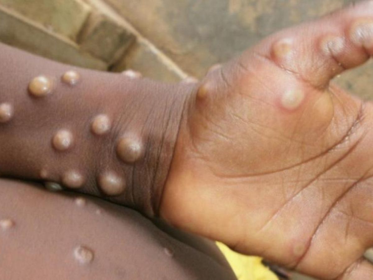 Sénégal/Mpox et Fièvre de la Vallée du Rift (FVR) : point sur la situation