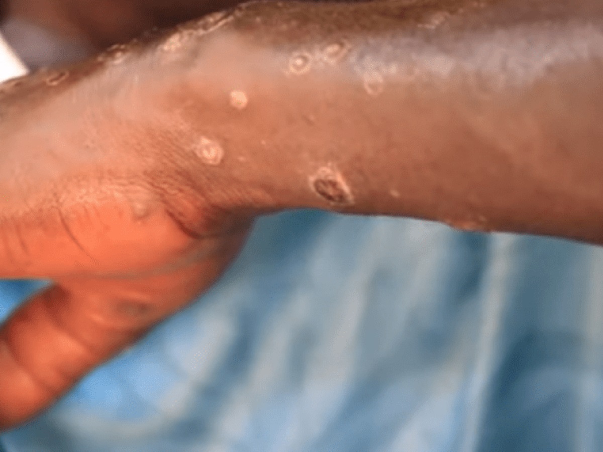Un homme testé positif au Sida, au Coronavirus et à la Variole du singe en même temps