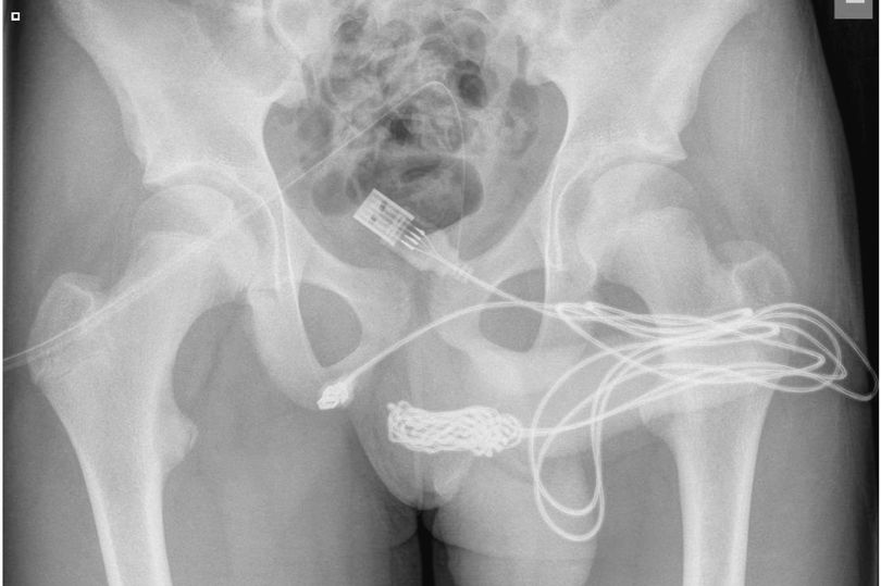 Un câble USB coincé dans le pénis d’un garçon lors d’une « expérimentation s3xuelle »